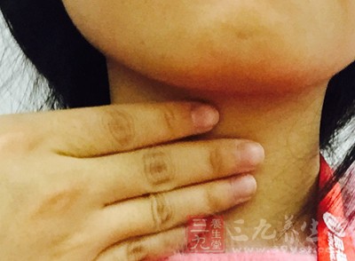 扁桃體發炎忌吃什麼