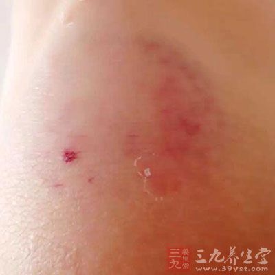 有少數患者開始皮損為紅色丘疹，可互相融合成斑片