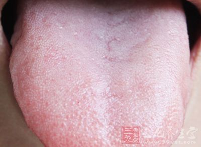吃槟榔引起的口腔黏膜白斑症常見於頰黏膜、舌、口底及唇角