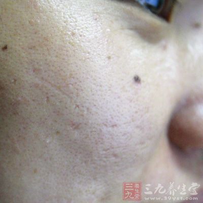 痘痘和黑斑的產生是造成肌膚衰老的主要元凶