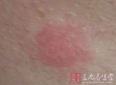 上吐下瀉，全身發紅，奇癢難耐