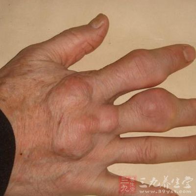 稍微不注意痛風就會發作