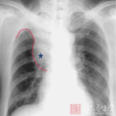 生活中肺癌嚴重的威脅著我們生活質量