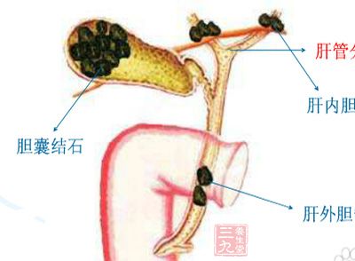 膽囊結石的形成，在我們飲食的不規律導致肝細胞合成的膽汁中膽固醇處於過飽和狀態