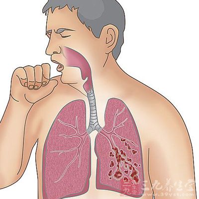 多由溶血性鏈球菌,其次為流感嗜血桿菌、肺炎球菌、葡萄球菌等引起 多由溶血性鏈球菌,其次為流感嗜血桿菌、肺炎球菌、葡萄球菌等引起