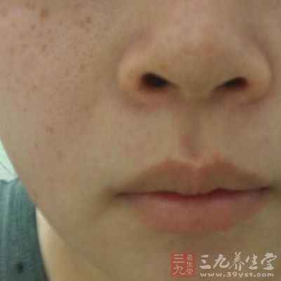 我們大部分人都認為臉上長痘痘的原因是油脂分泌過多堵塞毛孔造成的 我們大部分人都認為臉上長痘痘的原因是油脂分泌過多堵塞毛孔造成的