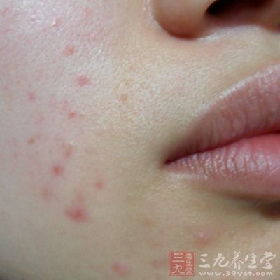 臉頰痘長痘痘主要的原因是肺部出了問題