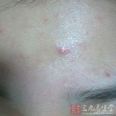 青春痘如果用手或工具去擠壓，非但於事無補，反而會因手上的細菌而造成二次感染