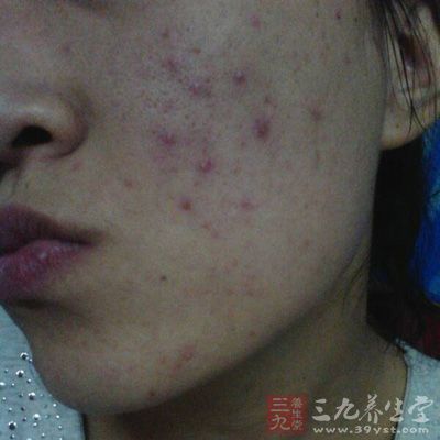 不同位置長痘的原因