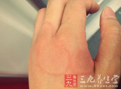 荨麻疹俗稱風疹塊