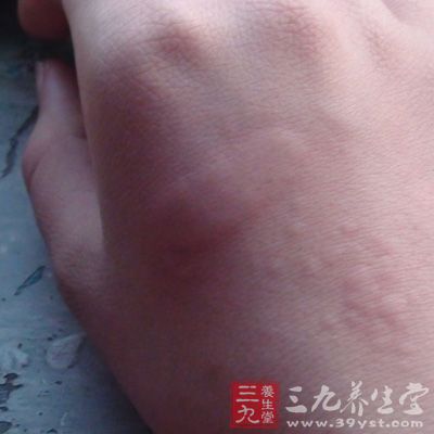 慢性荨麻疹由於病因復雜，難以尋找和去除，而導致病情容易反復發作，難以痊愈