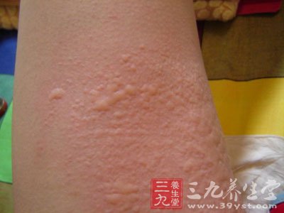 荨麻疹的發生主要是由於過敏變態反應所致