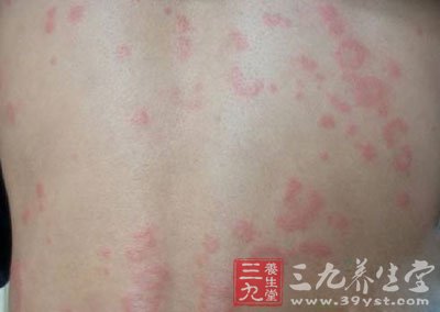 荨麻疹是一種相當常見的皮膚病