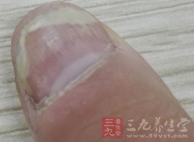 指甲受損的後果並不只限於觀賞本身