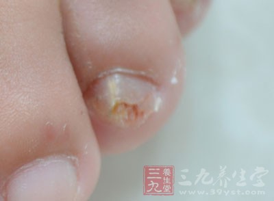 對於每一個愛美的人來說，有灰指甲是很難忍受的