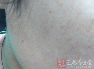 很多人的臉上會出現非常多的斑