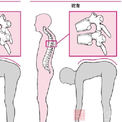 身長縮短、駝背 身長縮短、駝背