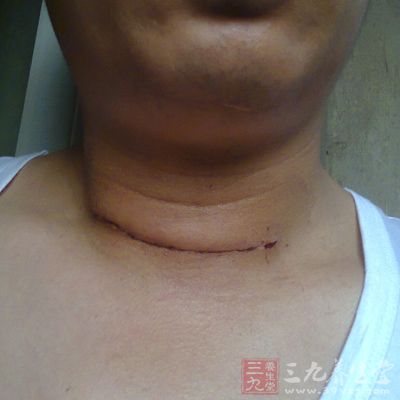 甲狀腺疾病嚴重的甲狀腺功能低下或甲狀腺功能亢進