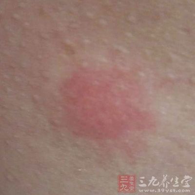 過度使用會導致灼傷，並會使皮膚發紅、脫皮和疼痛