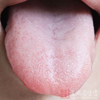 胃脹痛、嗳氣頻繁，反酸、舌質紅、舌苔白